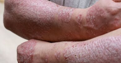 Académica PUCV explica qué ocurre en la piel durante la sarna noruega y por qué puede albergar millones de ácaros